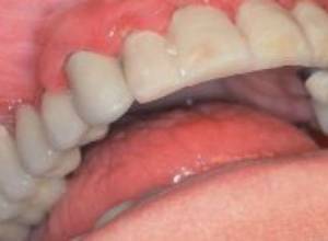 Պարադոնտոզի պատճառ` ջուրը