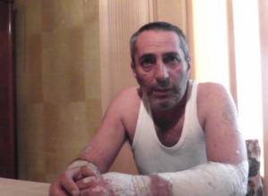 «Մարդիկ փտում են, իրենք կայֆավատ են ըլնում». փսորիազով հիվանդն օգնության կարիք ունի