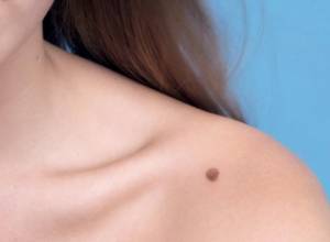 В Армении в 2016-м зарегистрировано 502 случаев меланомы