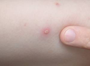 «Ветрянка» отступает?