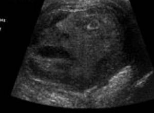 Опухоль в виде лица человека