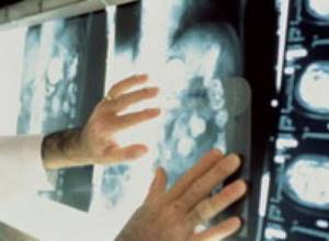 200 women die of cervical cancer in Armenia every year