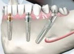 Bredent Medical company of Germany sees great potential in dental implantology development in Armenia 