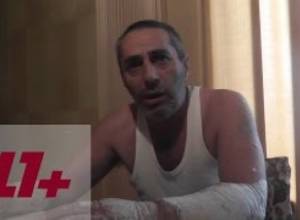 «Մարդիկ փտում են, իրենք կայֆավատ են ըլնում». փսորիազով հիվանդն օգնության կարիք ունի