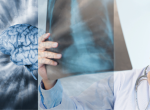 Ուղեղի ու թոքերի աշխատանքի խնդիրներ` կովիդից բուժվածներից ոմանց մոտ