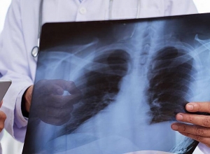 Աշխարհում տարեկան 450 միլիոն մարդ հիվանդանում է թոքաբորբով. մահվան ելքով ավարտվում է 7 միլիոնը