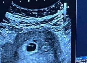 Զոհված զինվորների մայրերից առաջին հղին այսօր բժշկին է այցելել