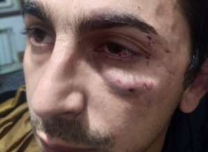 Խոշտանգման դեպք  ոստիկանական բաժանմունքում․ Փաստաբանը լուսանկարներ է հրապարակել