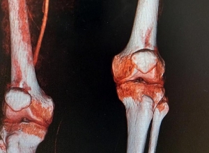 Փտախտից փրկեցին, ոտքը պահպանեցին․հաջողված վիրահատություն