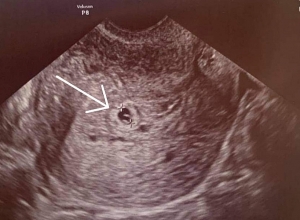 44-օրյա պատերազմում եղբորը կորցրած կինը հղիացել է երկար տարիների անպտղությունից հետո