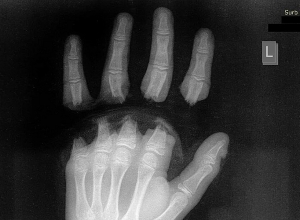 ԲԿ է ընդունվել երեխա՝ ձեռքի 4 մատների ամպուտացմամբ․ դեպքը տեղի է ունեցել շան հետ խաղալիս