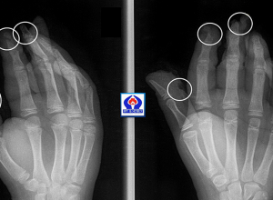 Ճայթուկը պայթել է երեխաների ձեռքերի մեջ․ անդամահատվել են մատներ