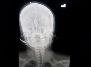 Պակիստանում հղի կինն իր գլխին մեխ է խփել, որ տղա երեխա լույս աշխարհ բերի