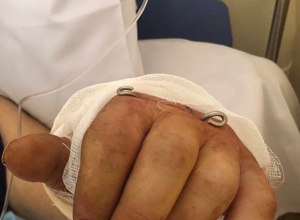 Ամբողջական կտրված դաստակը 8 ժամ տևած վիրահատությամբ վերականգնել են