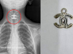 «Սուրբ Աստվածամայր» ԲԿ-ի բժիշկները չորս տարեկան երեխայի կերակրափողից հեռացրել են մետաղյա կախազարդ