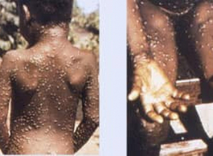  Հիվանդությունների վերահսկման և կանխարգելման Ազգային Կենտրոնը հայտարարություն է տարածել կապիկի ծաղիկ հիվանդության մասին