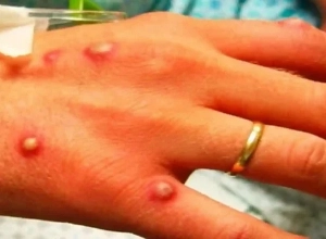 В Британии выявили 36 новых случаев заражения оспой обезьян