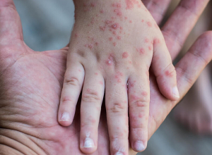 ԱՄՆ-ում գրանցվել են երեխաների շրջանում կապիկի ծաղիկի առաջին դեպքերը