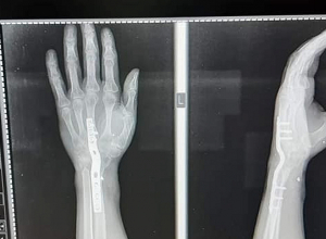 Այսօր ինձ զրկեցին հաշմանդամության կարգից․ վիրավոր տղերքին կոչ եմ անում միավորվել և միասին պայքարել․ պատերազմի մասնակից