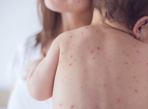 Ու՞մ համար է վտանգավոր կարմրուկը