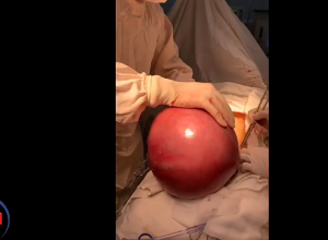 51-ամյա կնոջ մոտ հայտնաբերվել է շուրջ 9 կգ քաշով միոմատոզ հանգույց