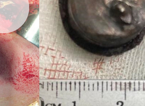 Երեխայի ձախ այտի փափուկ հյուսվածքներում հայտնաբերվել է մոտ 2.1-2.6 սմ մետաղական օտար մարմին