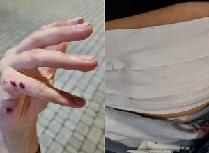 Ոստիկանությունը լուսաձայնային նռնակներ է կիրառել. վնասվածք է ստացել նաեւ Հետք Մեդիա Գործարանի լրագրողը